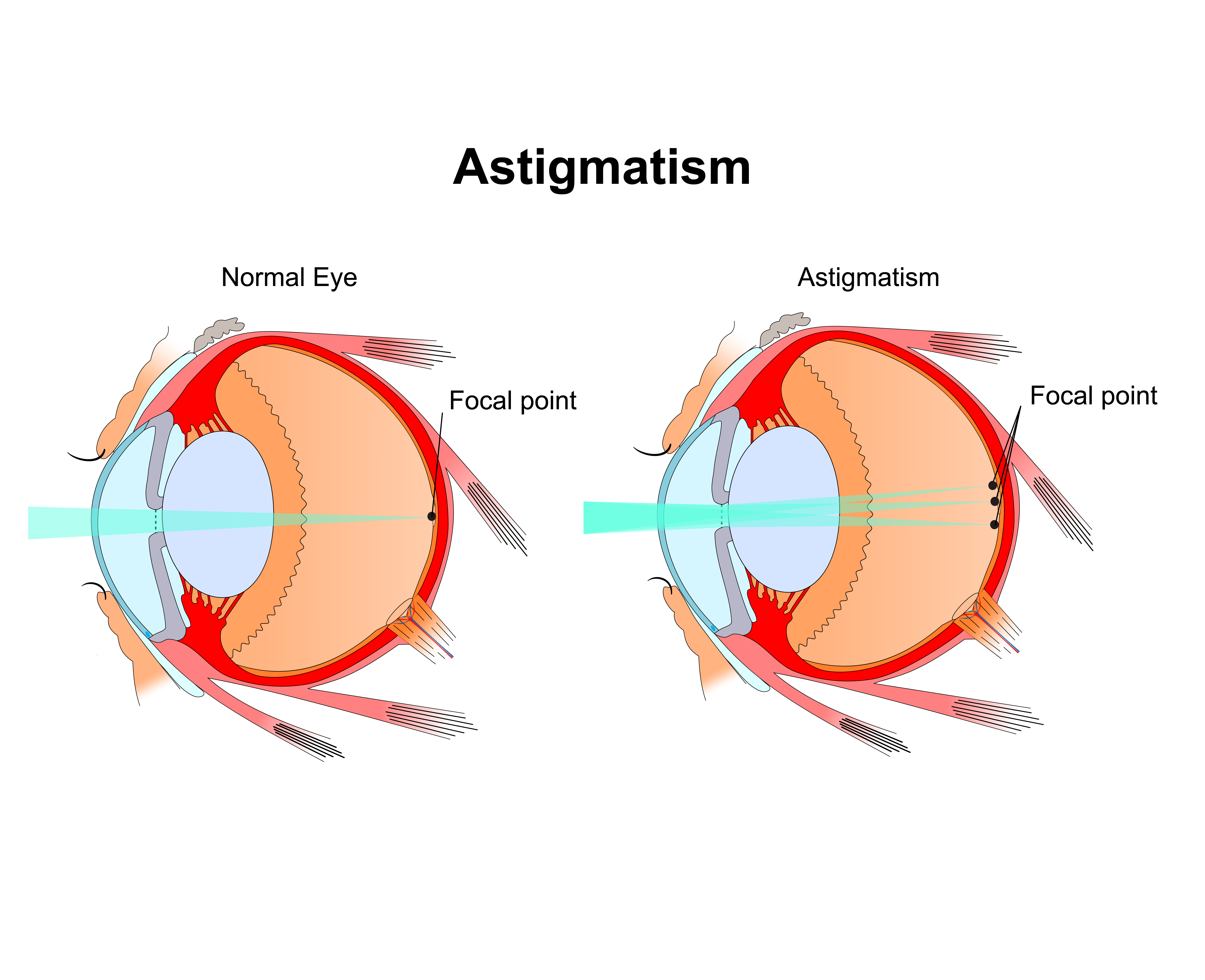 Astigmatism vs Normal Eye
